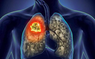 Dia Mundial do Cancro do Pulmão