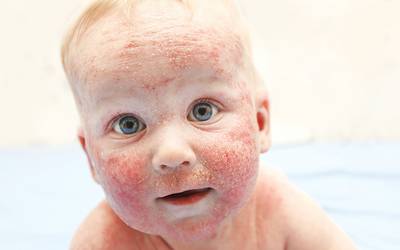 Nova terapia medicamentosa para crianças com eczema grave
