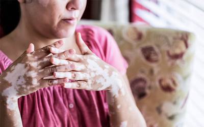 Vitiligo: novo tratamento restaura coloração da pele