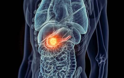 Cancro do pâncreas pode ser diagnosticado até três anos mais cedo