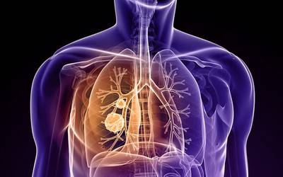 Fármaco para cancro do pulmão promissor em ensaio de fase I/II