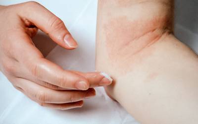 Cientistas testam nova maneira de tratar eczema