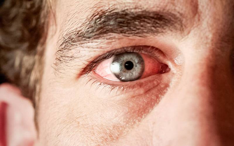 Doença do olho seco altera forma como córnea se cura após lesão