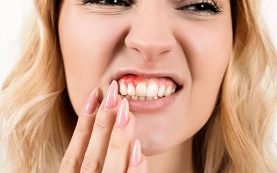Doença do refluxo gastroesofágico aumenta risco de periodontite
