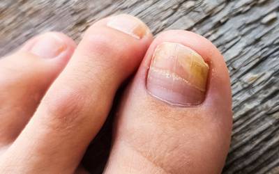 Onicomicoses: proteja os seus pés das infeções fúngicas