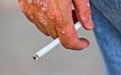 Fumar independentemente associado a maior risco de psoríase