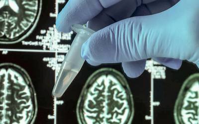 Alzheimer: proposto novo biomarcador para o diagnóstico precoce