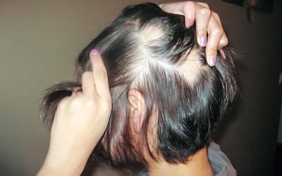 Tratamento da alopecia areata em adolescentes avança