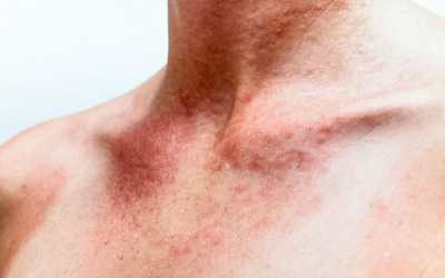 Alergia ao sol: saiba como prevenir e tratar