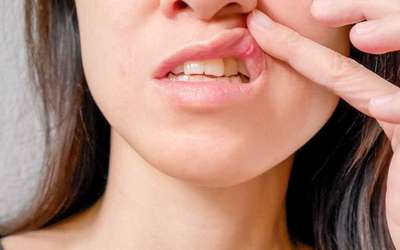 Sofre de aftose oral? Descubra como prevenir e tratar