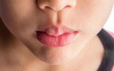 O que saber sobre acordar com o lábio inchado