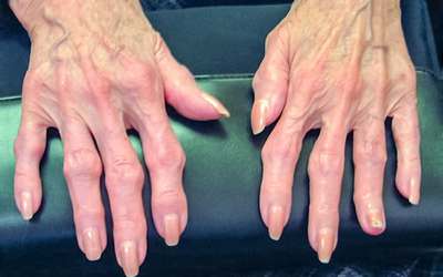 Fármaco comum pode melhorar sintomas de osteoartrite da mão