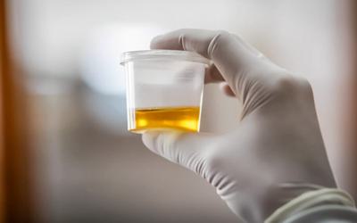 Cientistas descobrem enzima responsável pela tonalidade da urina