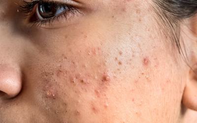 Desenvolvido novo tratamento para acabar com a acne
