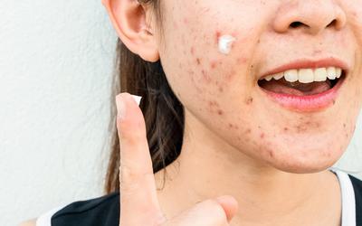 Detetado ingrediente tóxico em tratamentos para a acne