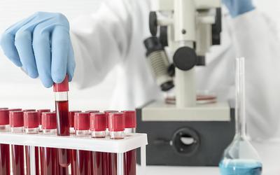 Novo teste de sangue pode determinar risco de AVC