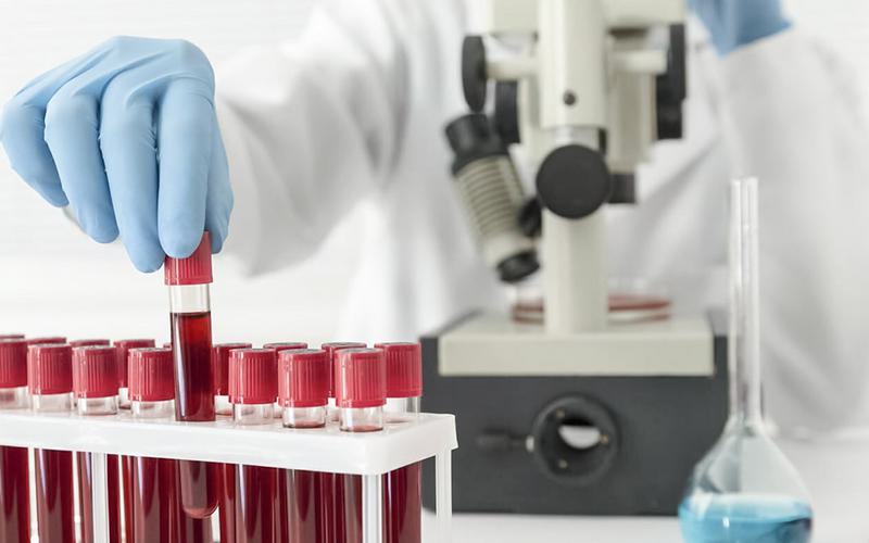 Novo teste de sangue pode determinar risco de AVC Novo teste de sangue pode determinar risco de AVC