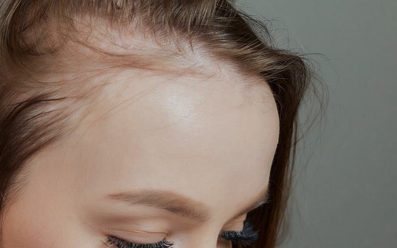 Pílula anticoncecional pode contribuir para alopecia cicatricial Pílula anticoncecional pode contribuir para alopecia cicatricial
