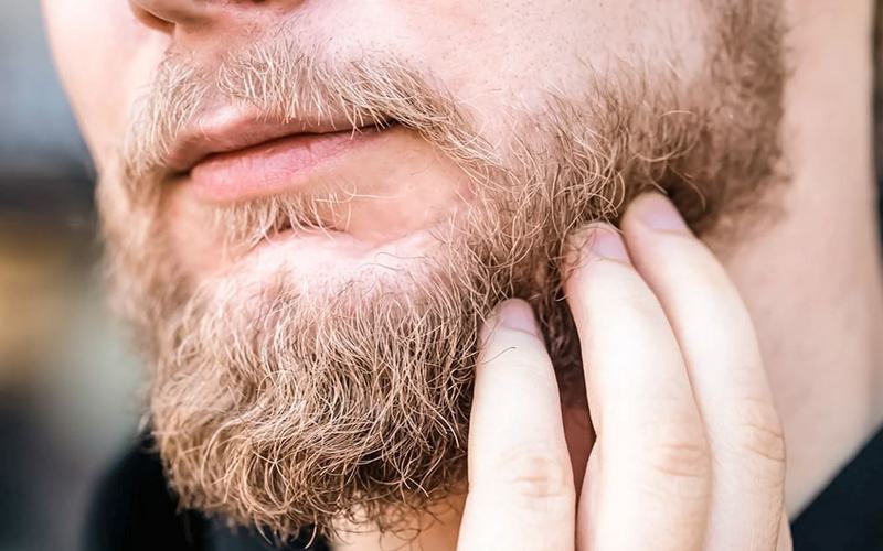 Caspa na barba: descubra as causas e soluções Caspa na barba: descubra as causas e soluções
