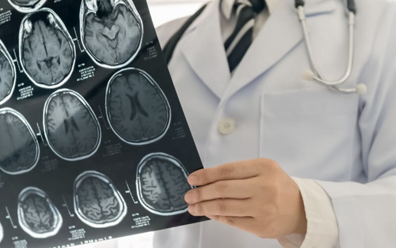 Inflamação identificada como causa potencial da progressão da EM Inflamação identificada como causa potencial da progressão da EM