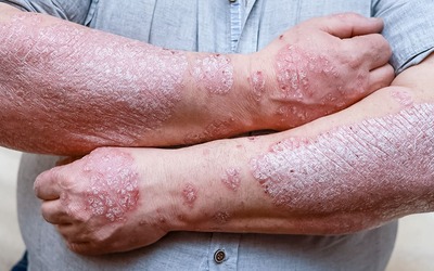 Psoríase associada a aumento do risco de distúrbios do sono