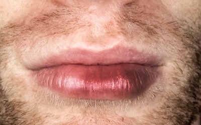 Aprovado garadacimab-gxii mensal para angioedema hereditário