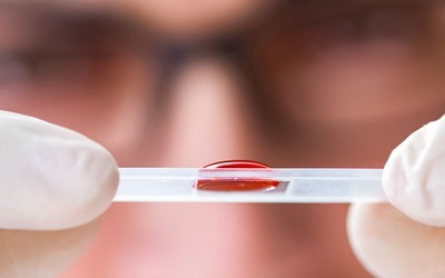Exame de sangue pode prever recidiva da EM