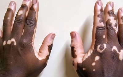 Vitiligo associado a maior risco de depressão em alguns pacientes