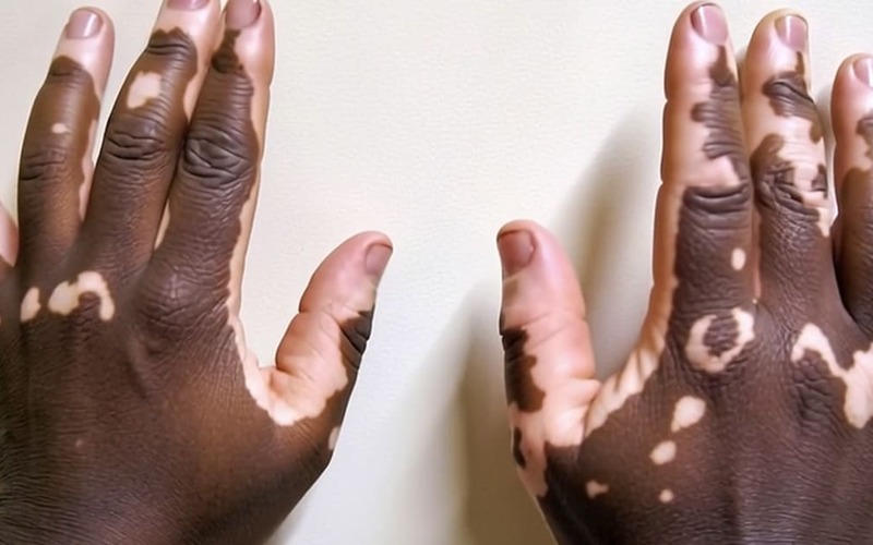 Vitiligo associado a maior risco de depressão em alguns pacientes Vitiligo associado a maior risco de depressão em alguns pacientes