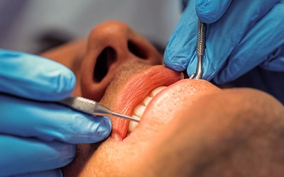 Doença gengival pode aumentar risco de AVC e danificar o cérebro