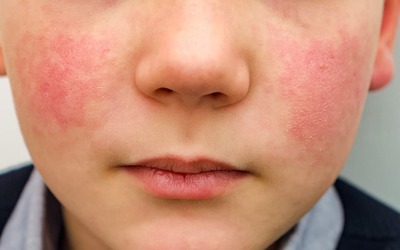FDA aprova ruxolitinib para dermatite atópica em crianças