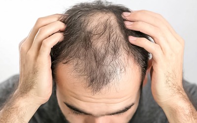 O que se come e bebe pode contribuir para a queda de cabelo