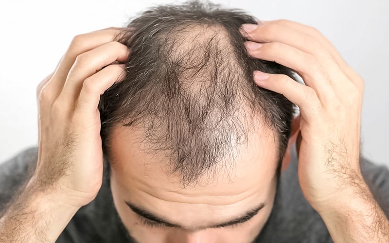 O que se come e bebe pode contribuir para a queda de cabelo O que se come e bebe pode contribuir para a queda de cabelo