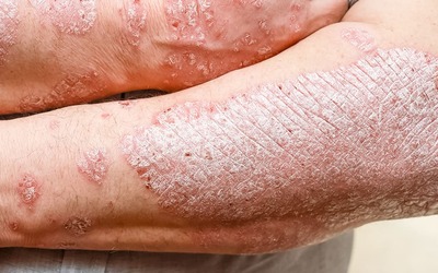 Icotrokinra é benéfica na psoríase em placas