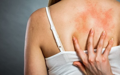 Pessoas com alergias têm maior risco de complicações cirúrgicas