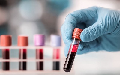 Proteínas no sangue estão ligadas ao desenvolvimento de DT2