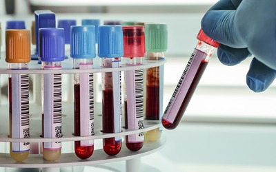 Obesidade acelera desenvolvimento de Alzheimer