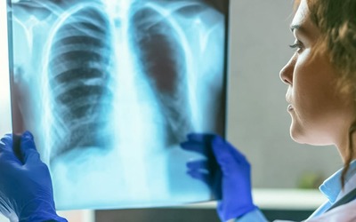 Notícias - FDA aprovou nerandomilast para a fibrose pulmonar progressiva