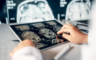 Novo anticoagulante reduz acidentes cerebrovasculares em 26%